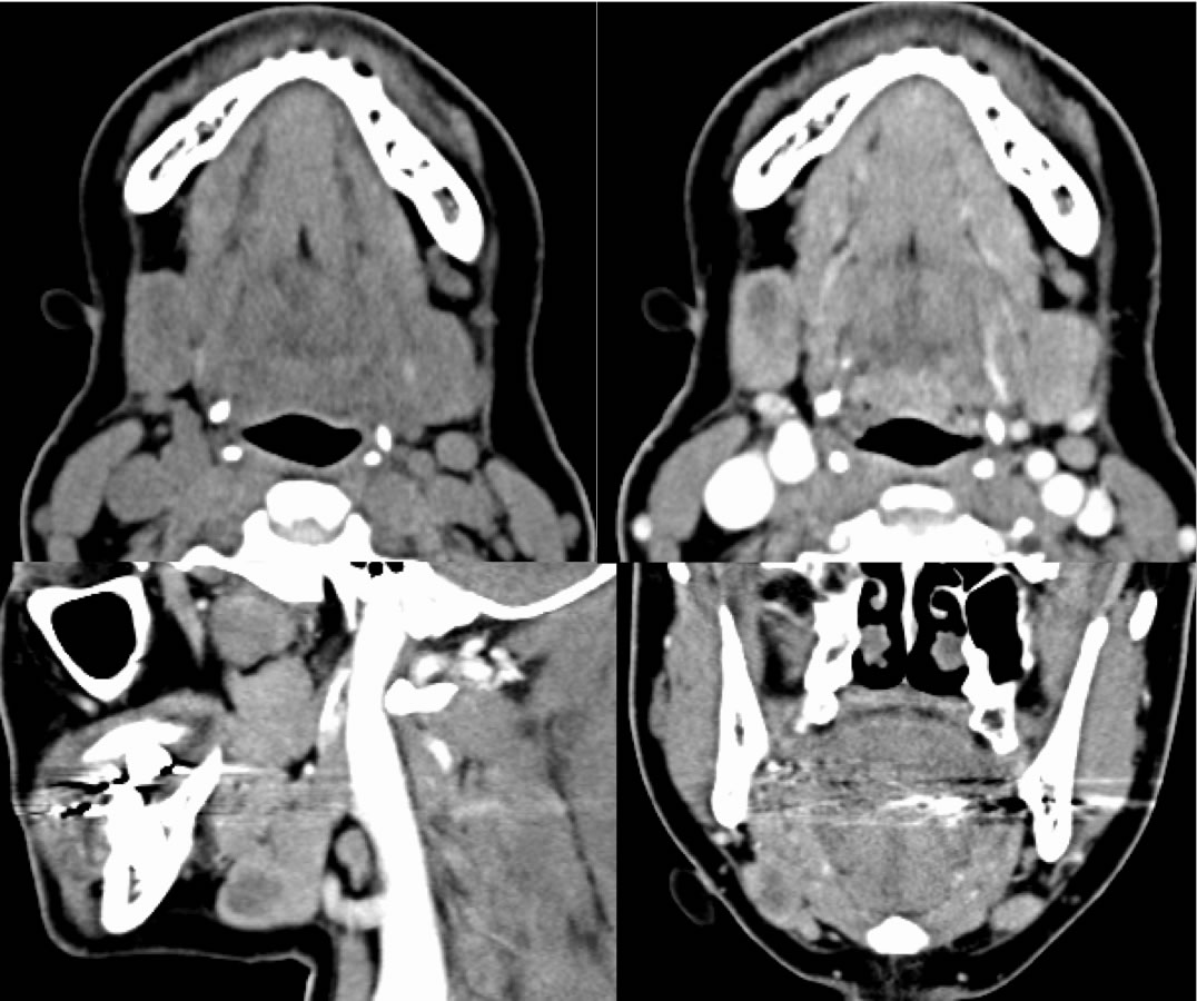 Adenoid Cystic Carcinoma 